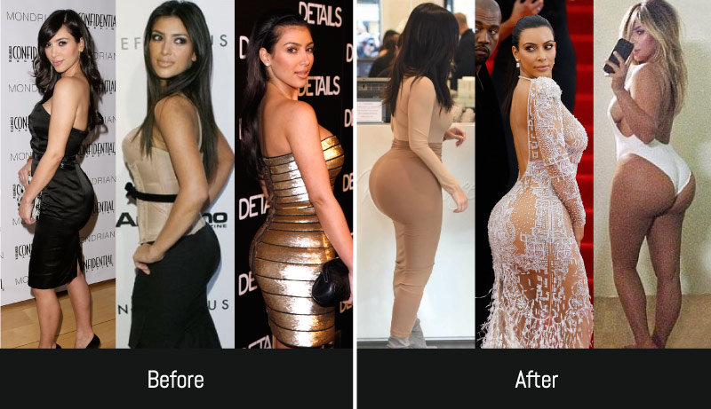 kim-kardashian-bbl-removal.jpg